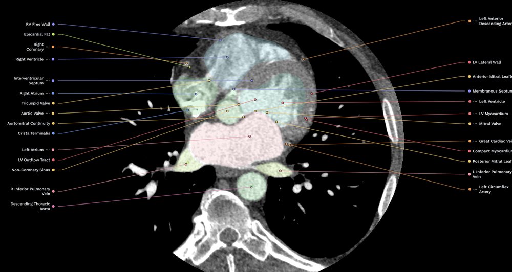 NavRad Anatomy cardiac CT with labelled chambers and colored overlays