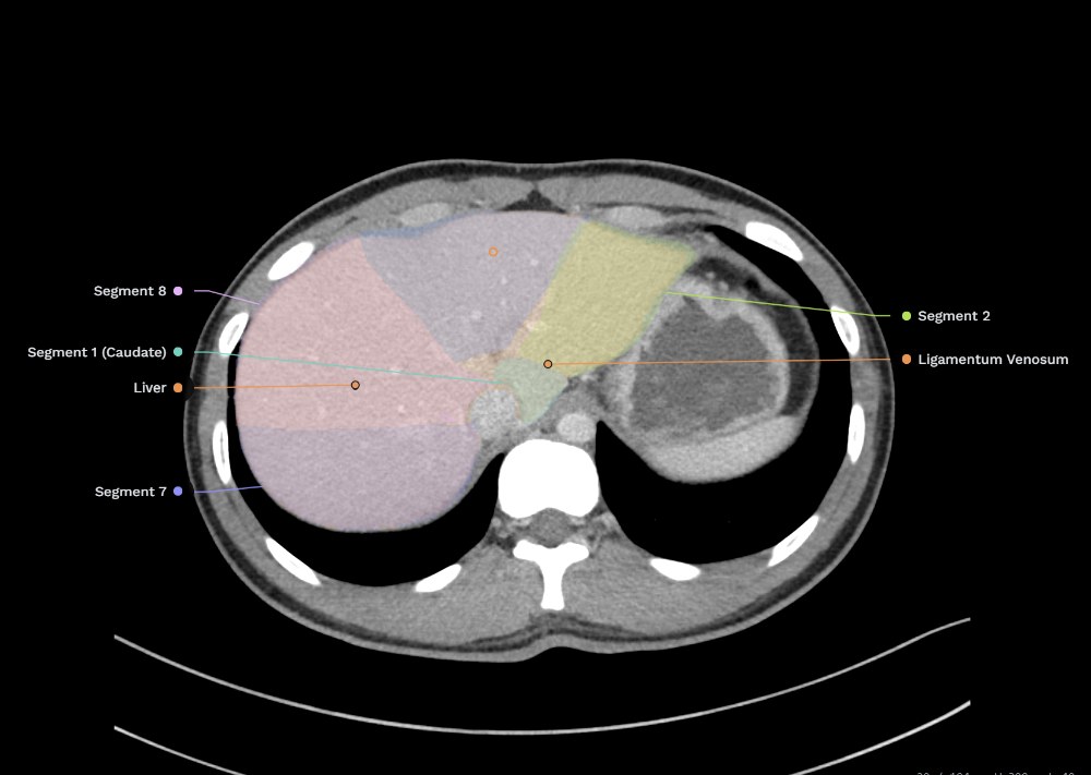 NavRad Anatomy CT abdomen showing labelled liver segments with colored overlays