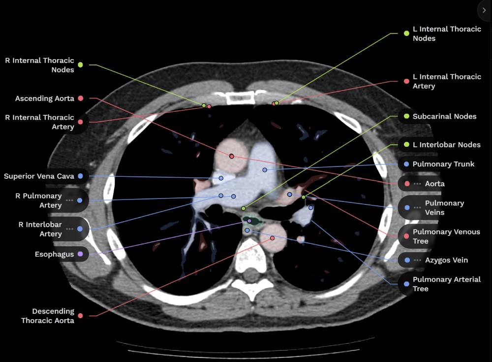 NavRad Anatomy CT chest with labelled structures and colored overlays