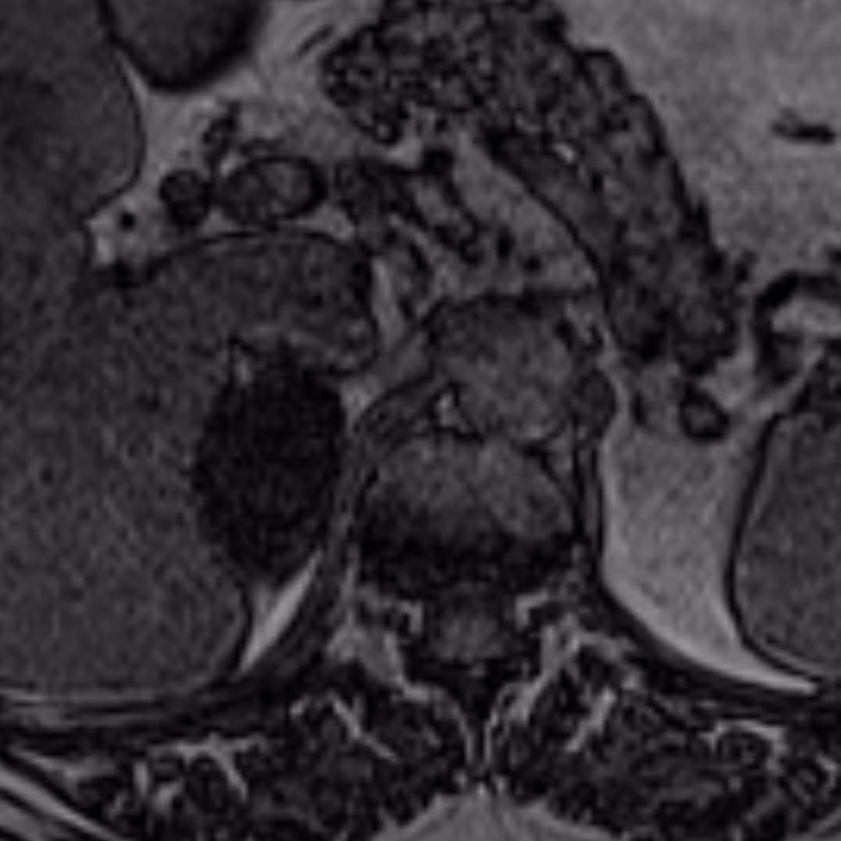 Sample case from Adrenal MRI