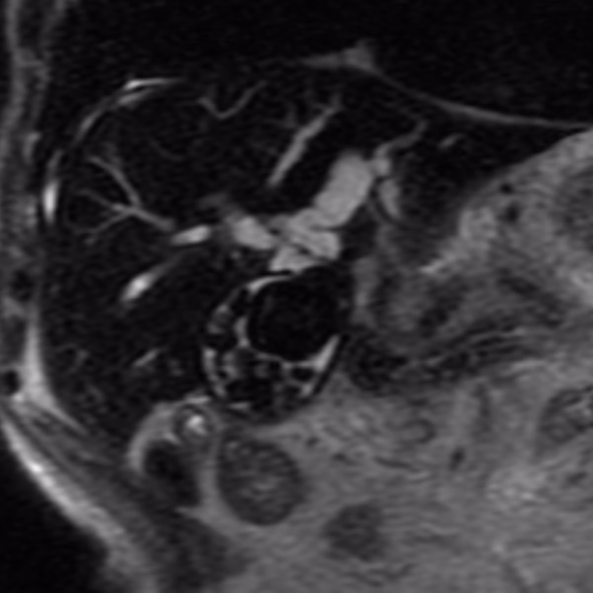 Sample case from Biliary MRI