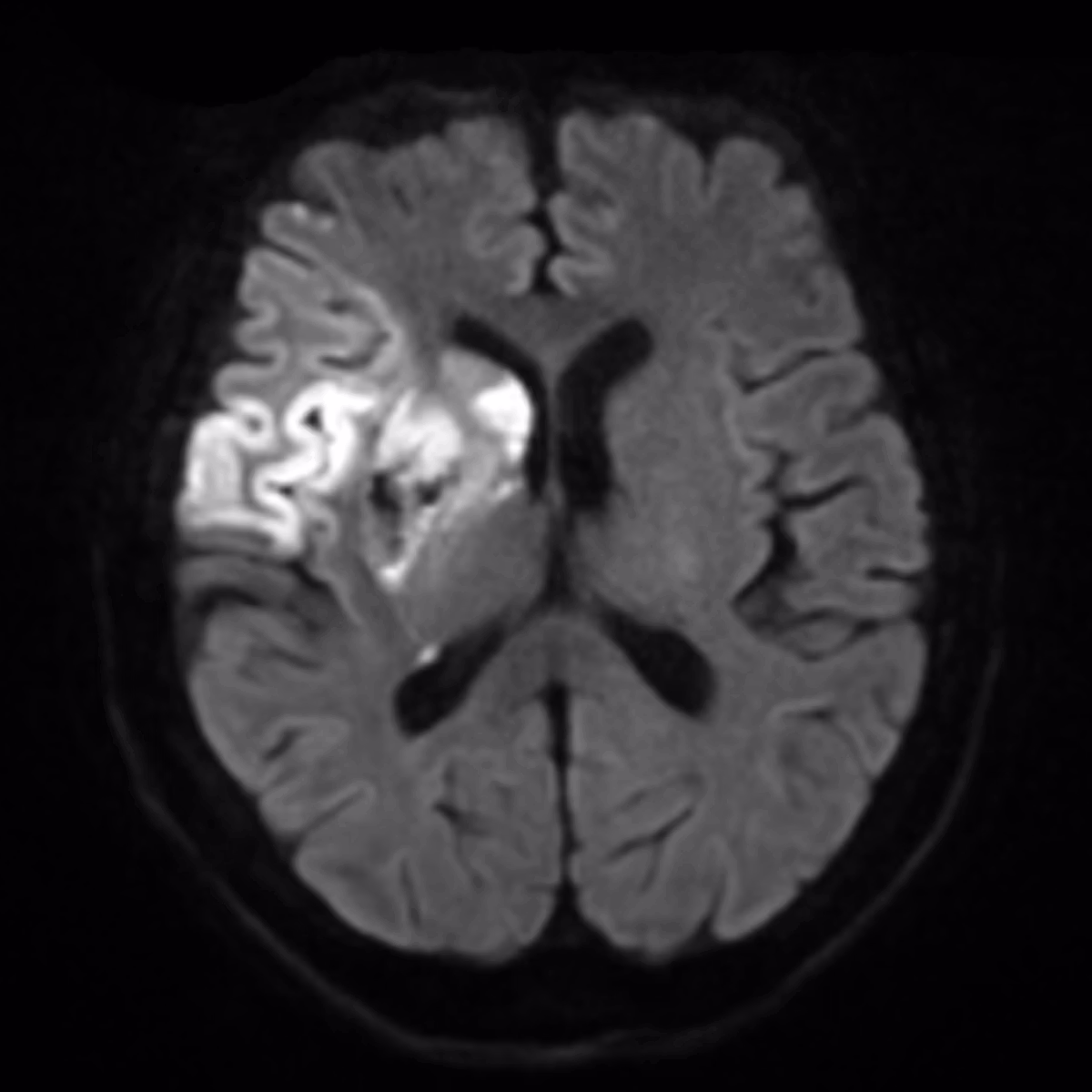 Sample case from Brain MRI