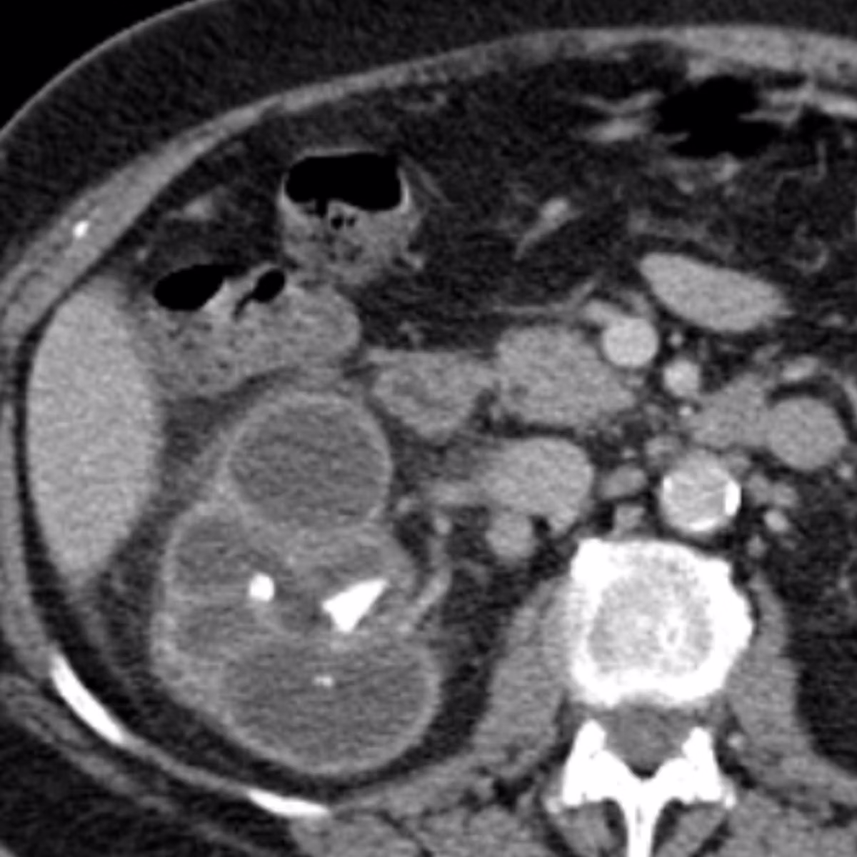 Sample case from CT Abdomen/Pelvis