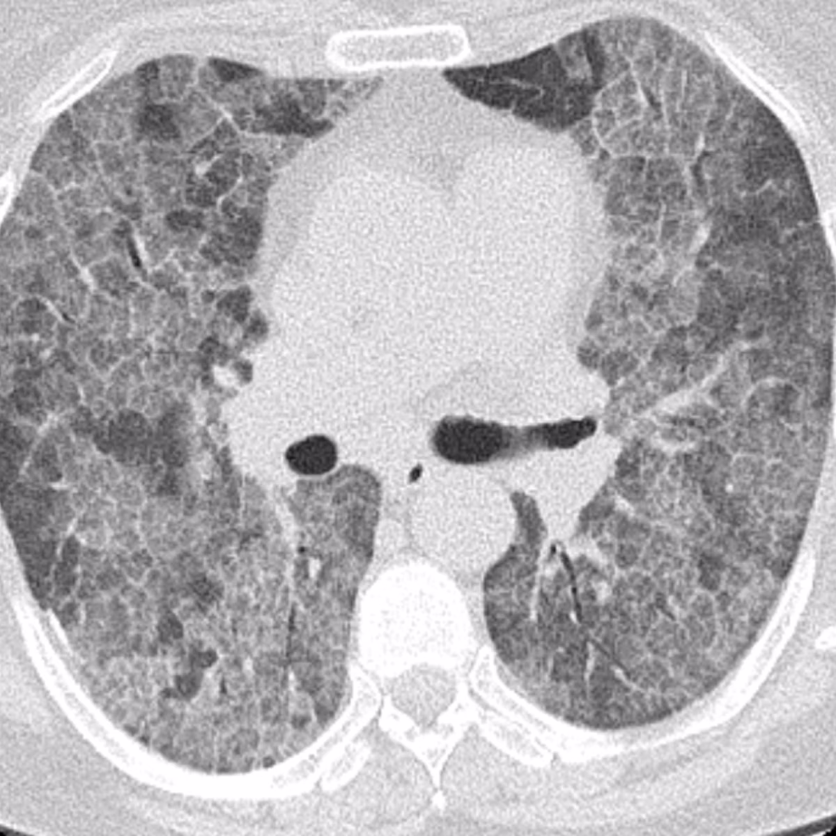 Sample case from CT Chest & CTPA