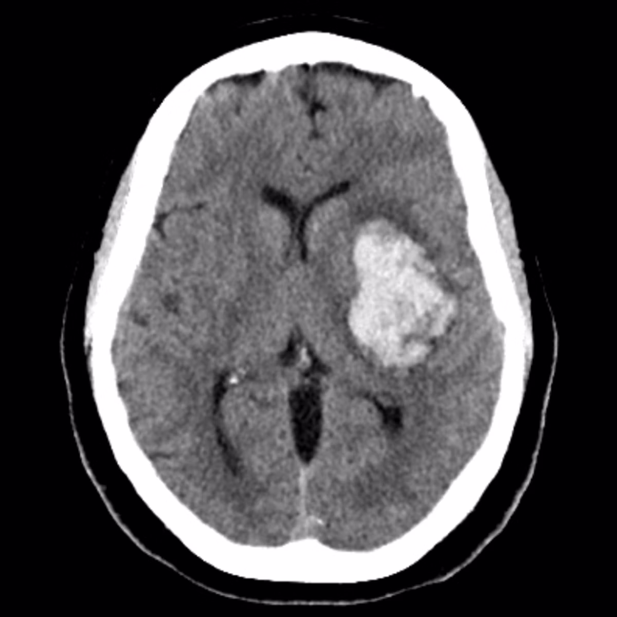 Sample case from CT Head & CTA Neuro