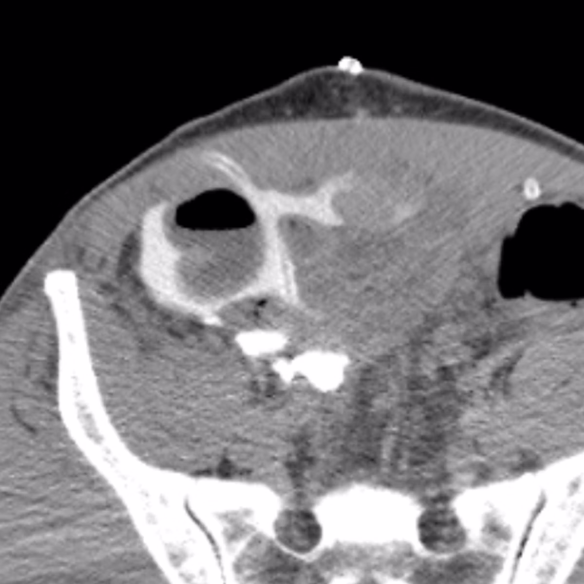 Sample case from CT Post-Op Abdomen