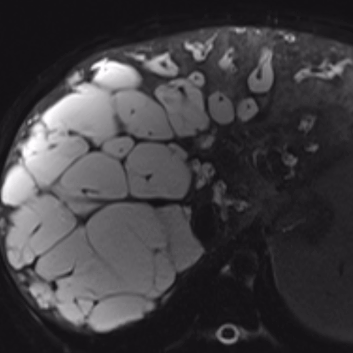 Sample case from Liver MRI