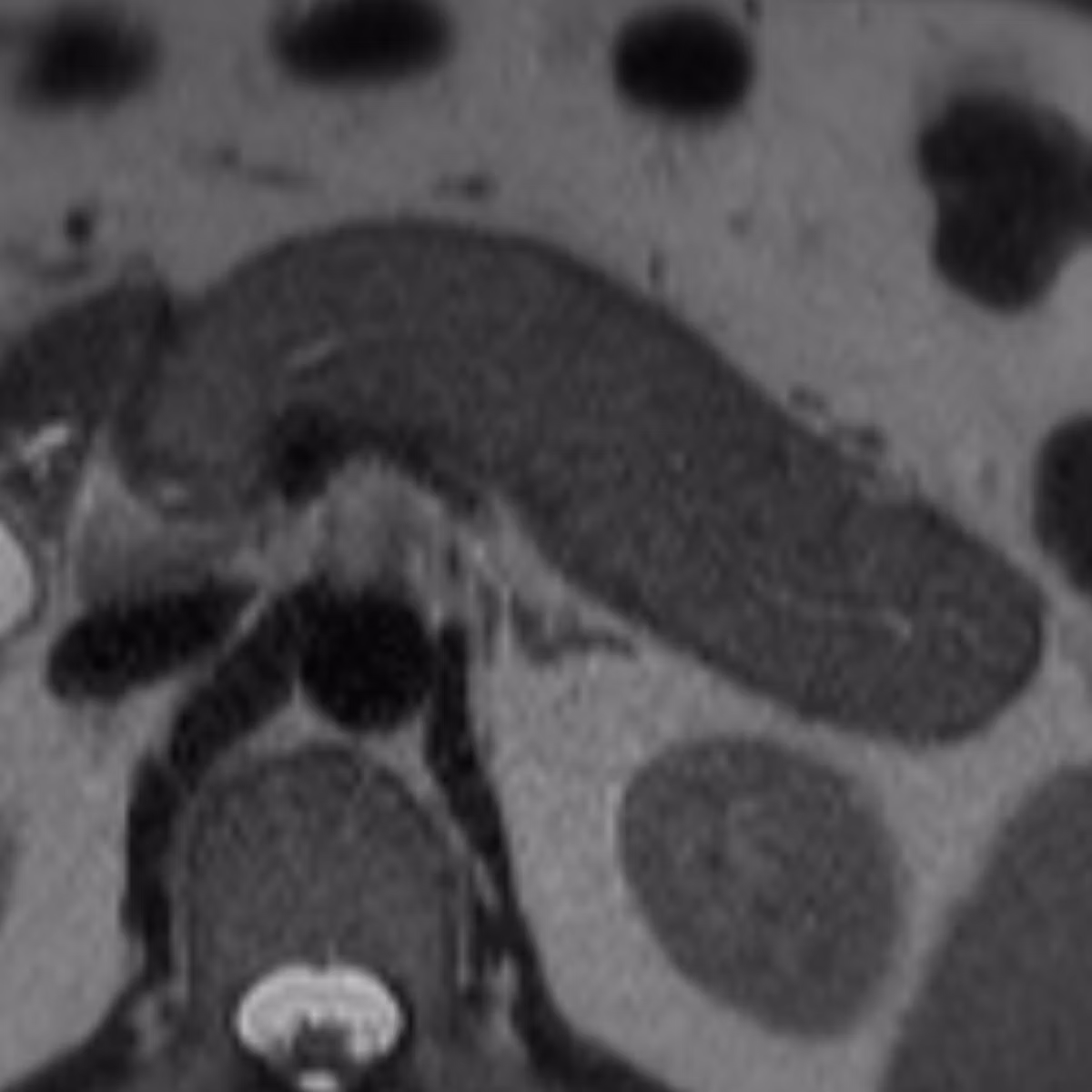 Sample case from Pancreas MRI