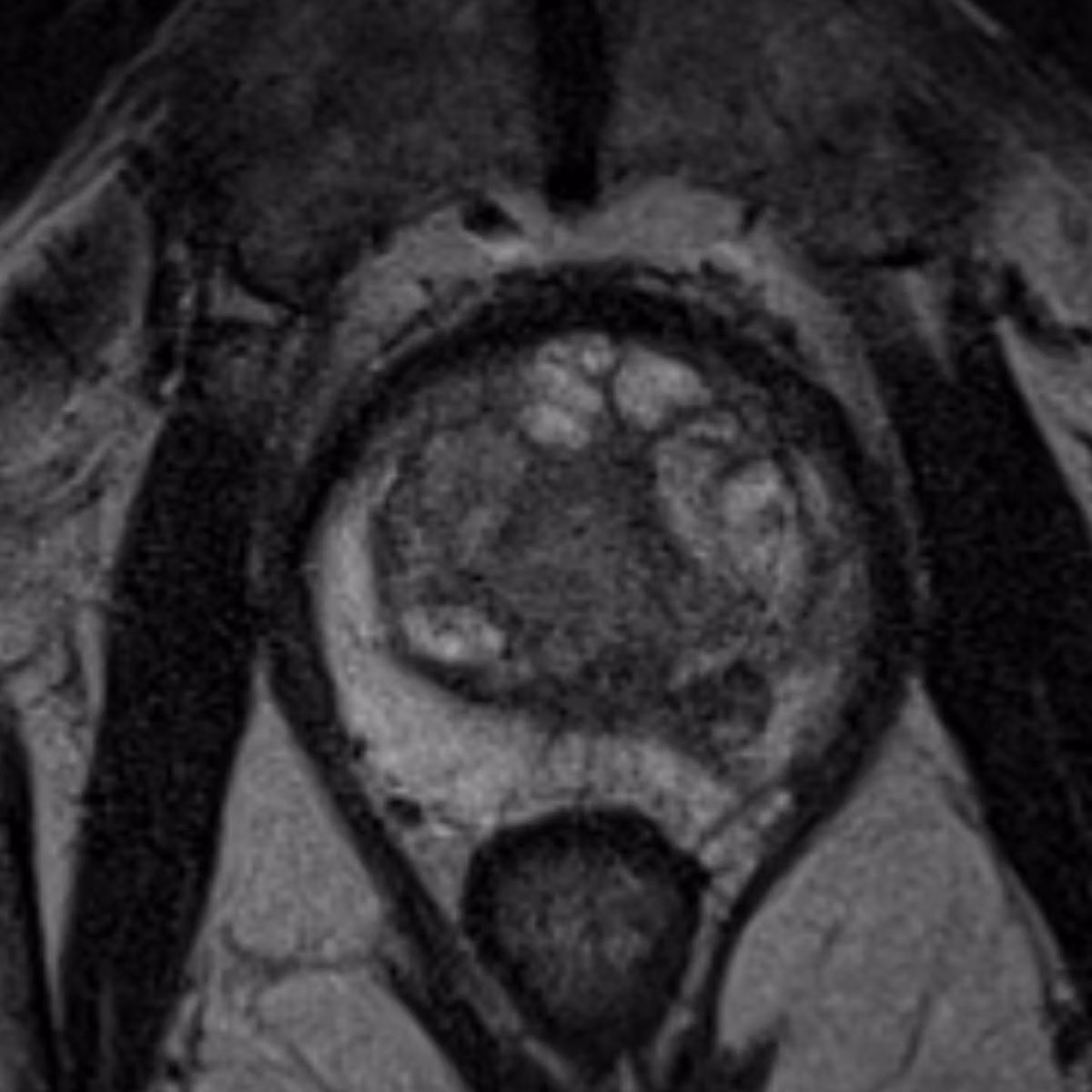 Sample case from Prostate MRI