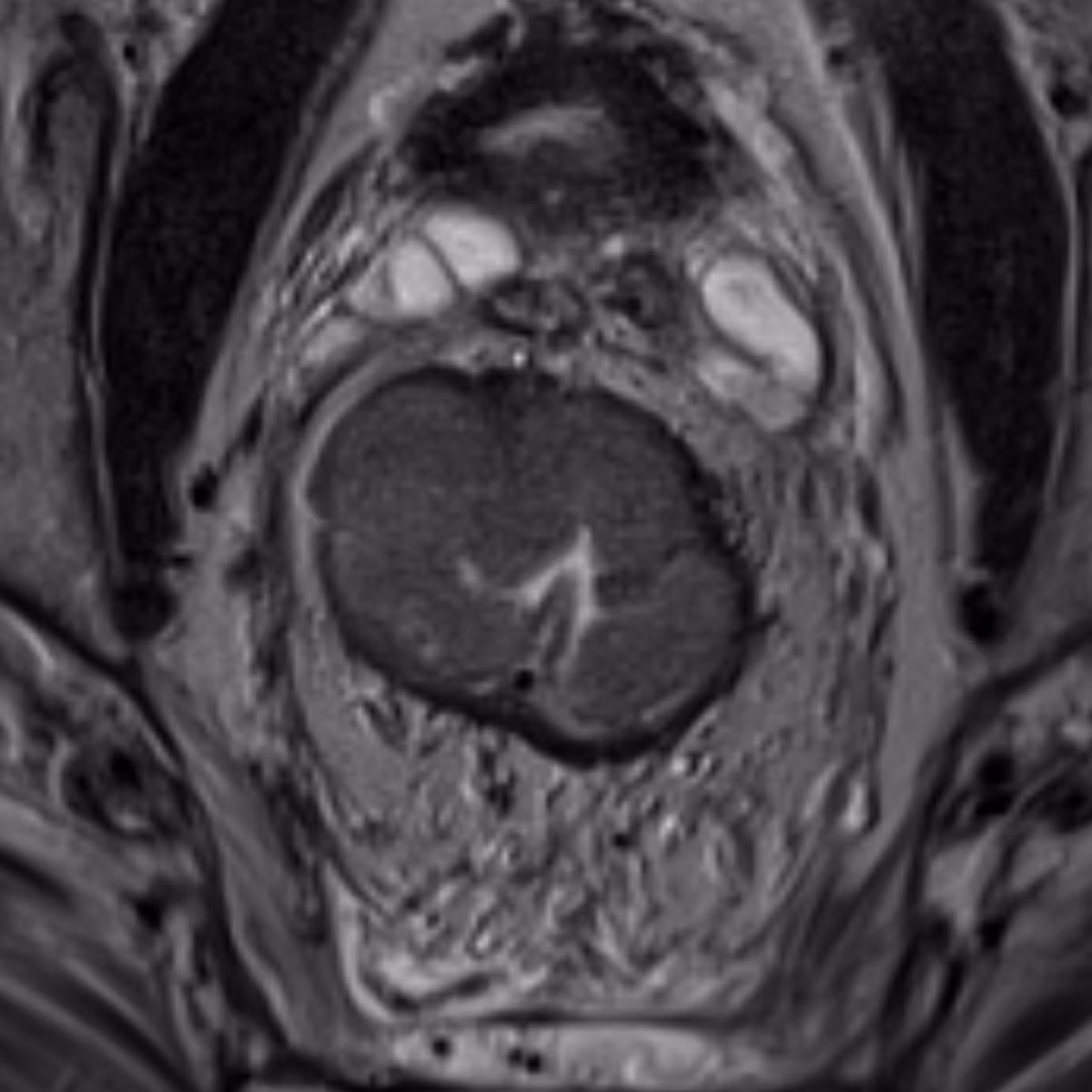 Sample case from Rectal MRI