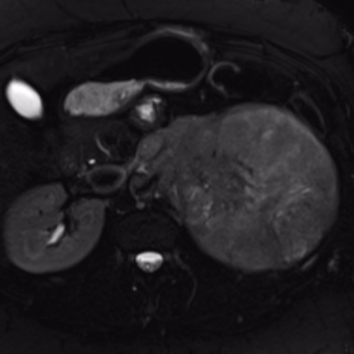 Sample case from Renal MRI
