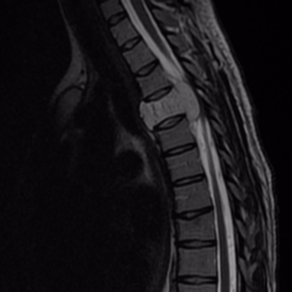 Sample case from Spine MRI